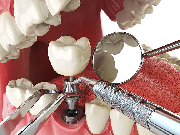 Best Emergency Wisdom Tooth Extraction in Schofield, WI